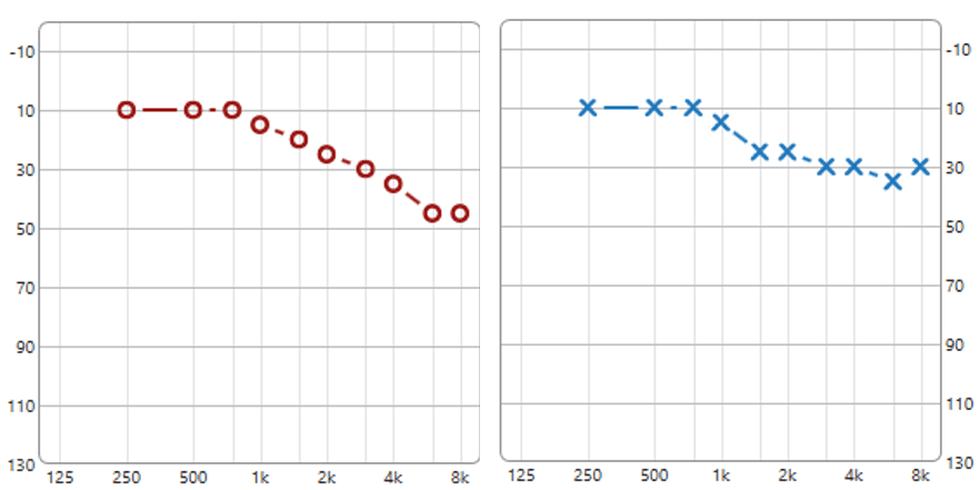 comment lire un audiogramme audioprothésiste